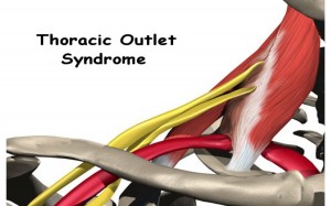 Thoracic-Outlet-Syndrome-Diagram-2