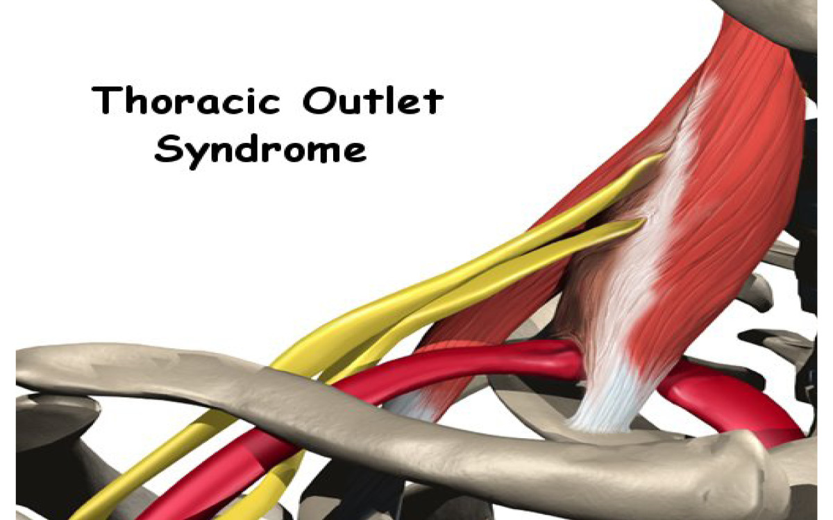Thoracic Outlet Syndrome Diagram 2