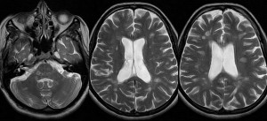multiple sclerosis