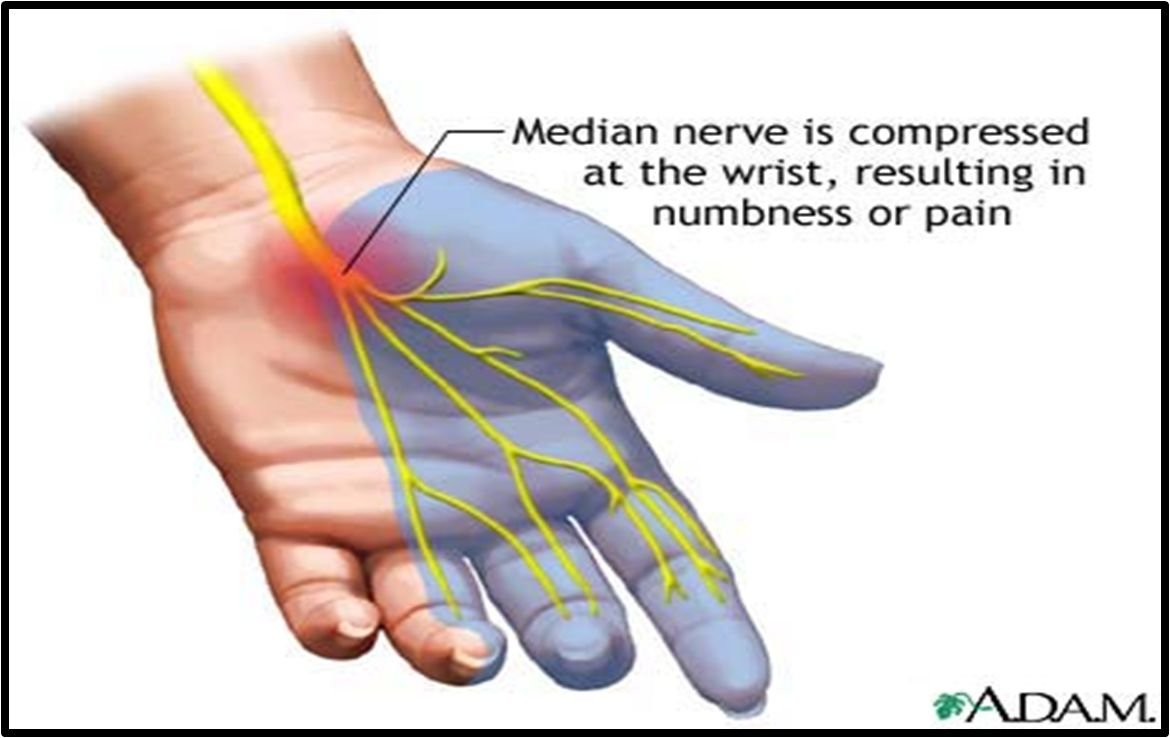 carpal tunnel syndrome anatomy 14
