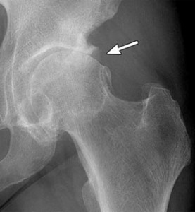 osteoarthritis